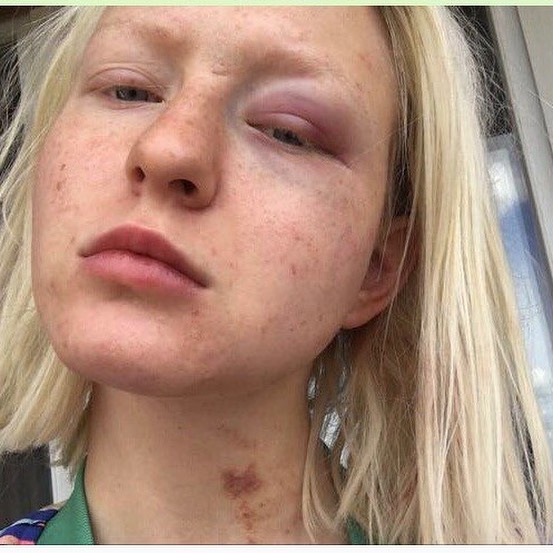 Тося Чайкина показала свое фото после избиения Ассаи