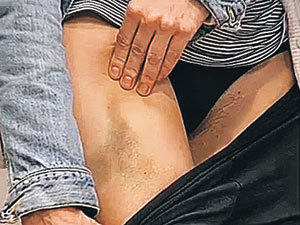 ... показала свои побои (Фото: НТВ)