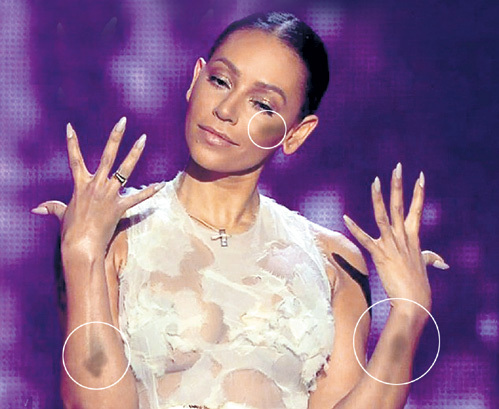 Во время недавнего телешоу «X Factor» зрители смотрели не на участников конкурса, а пялились на синяки члена жюри - Мел БИ